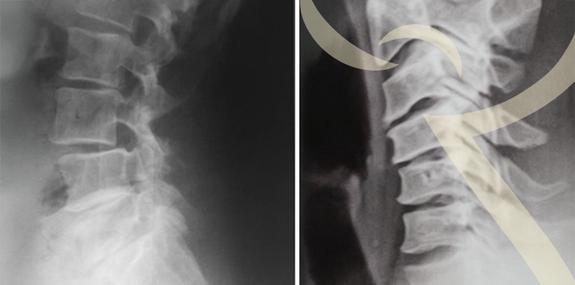 Imagem Infiltração Guiada por Ultrassom
