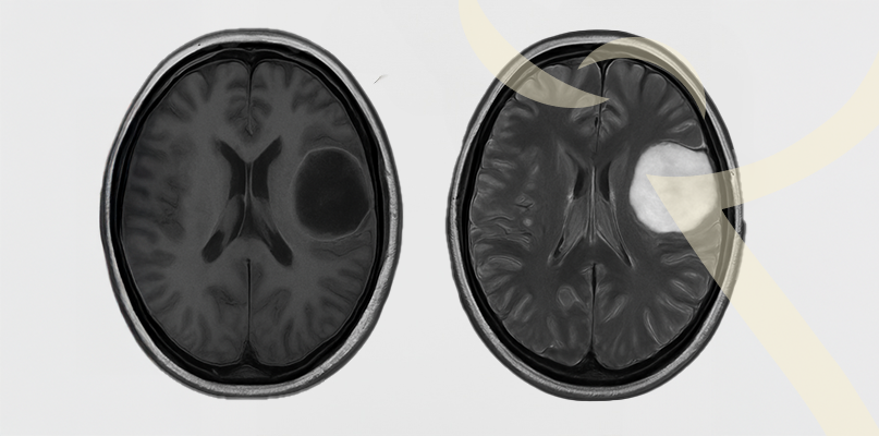 Imagem Infiltração Guiada por Ultrassom